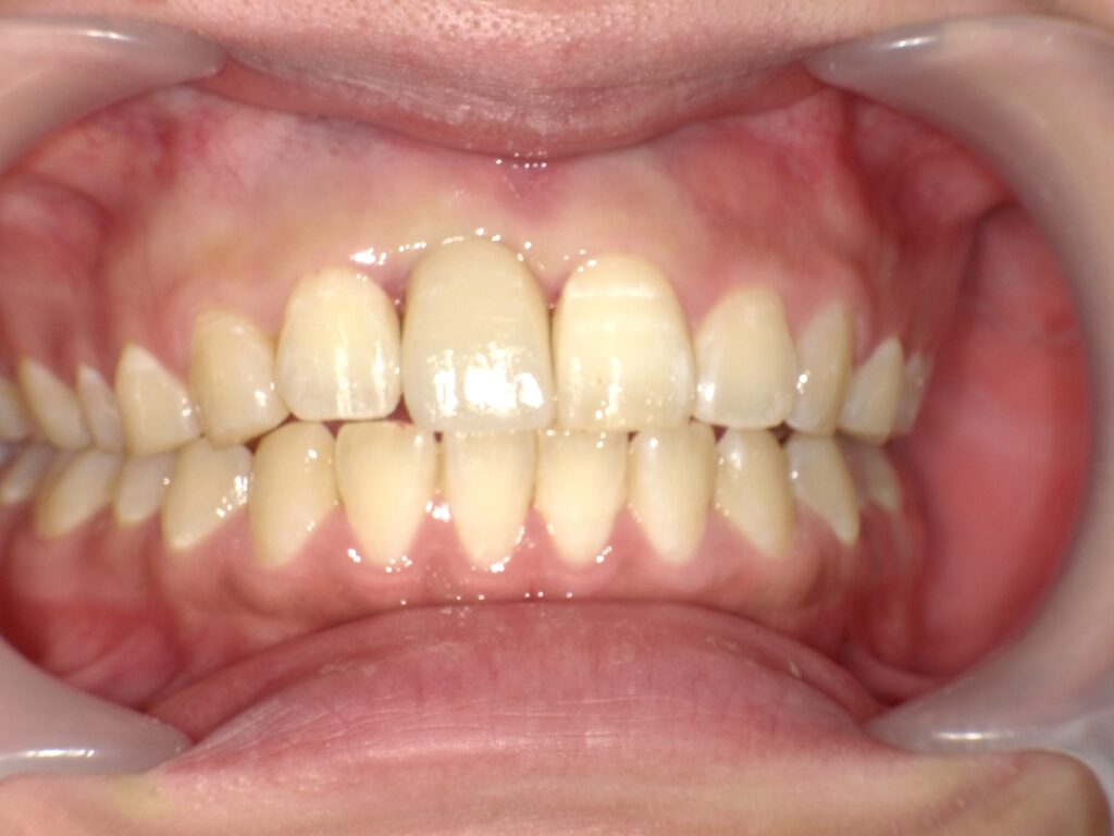 インプラント症例アフター