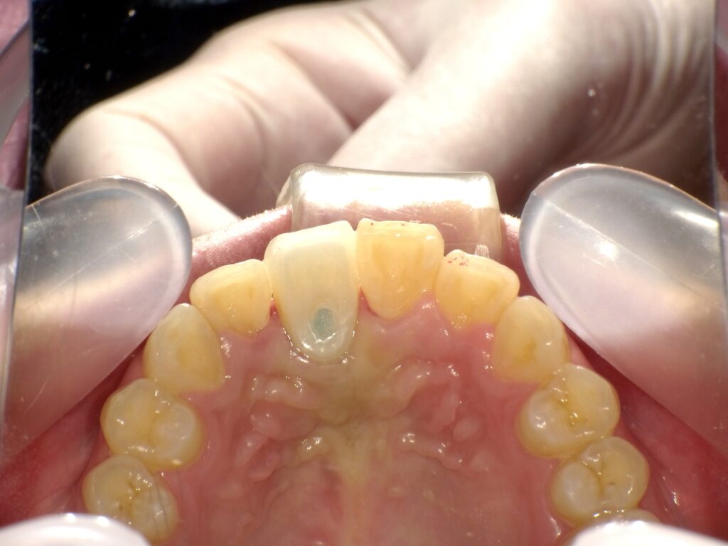 インプラント症例アフター