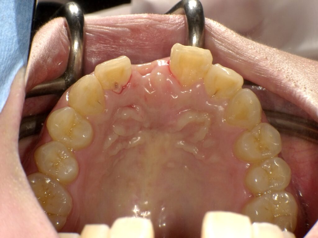 インプラント症例ビフォー