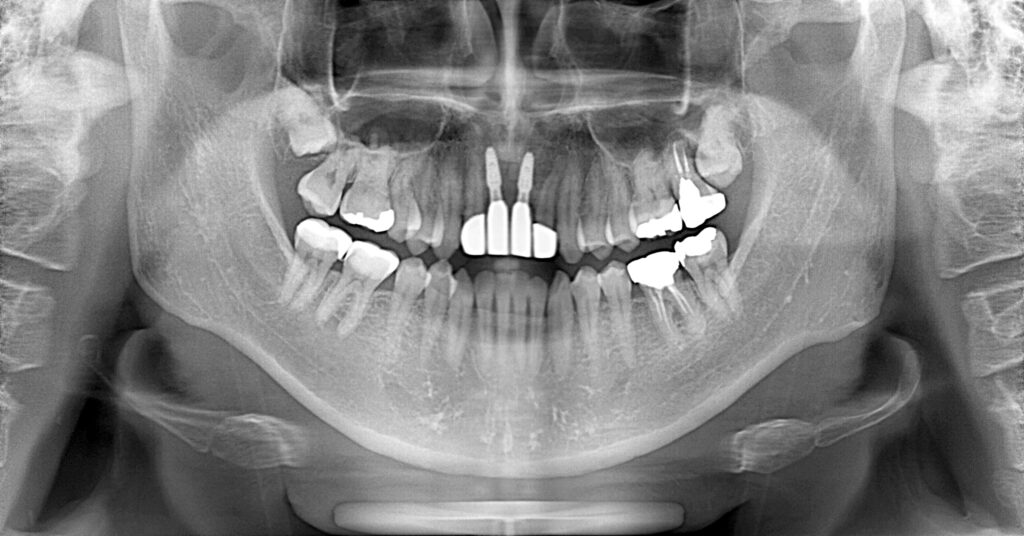 インプラント症例アフター