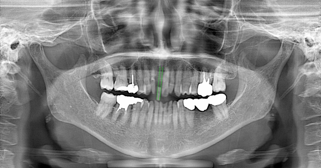 インプラント症例ビフォー