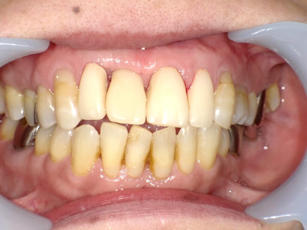 インプラント症例アフター