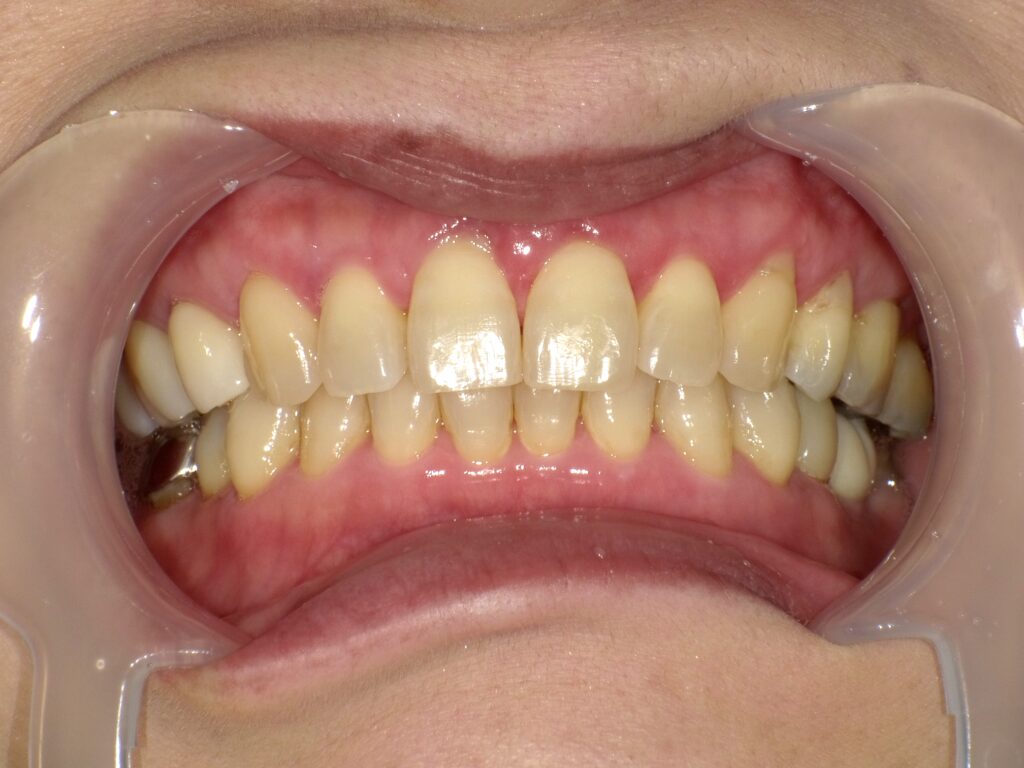 ホワイトニング症例ビフォー