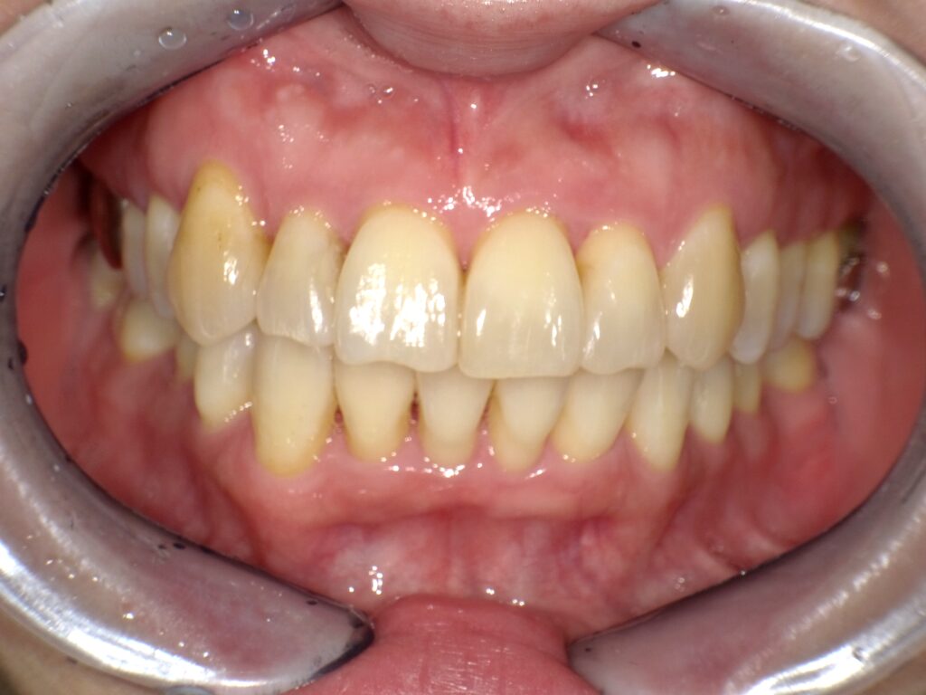 ホワイトニング症例ビフォー