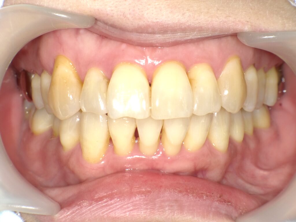 ホワイトニング症例アフター