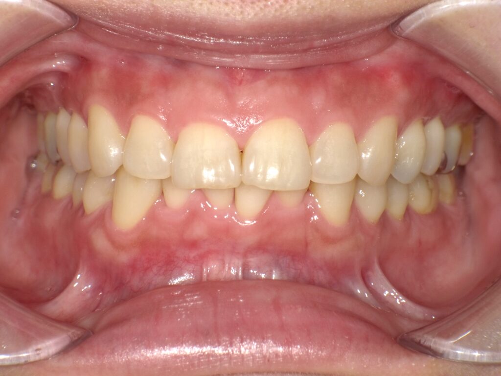 ホワイトニング症例ビフォー