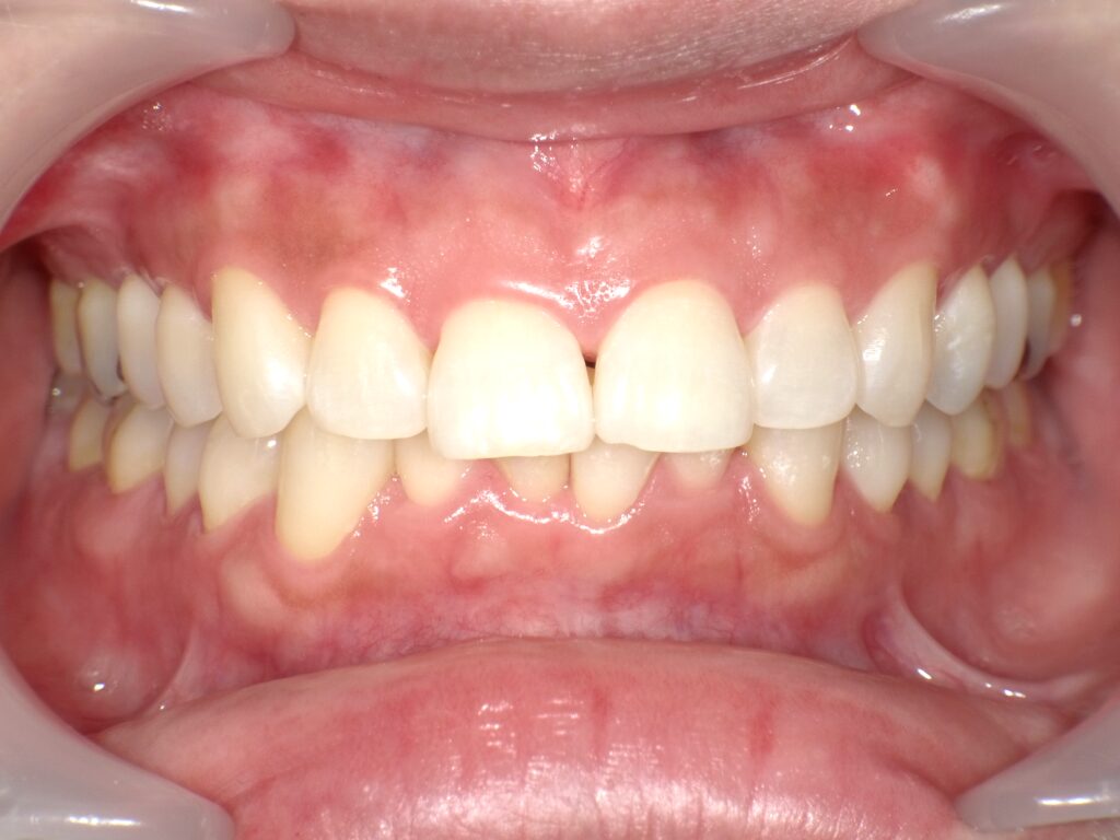 ホワイトニング症例アフター