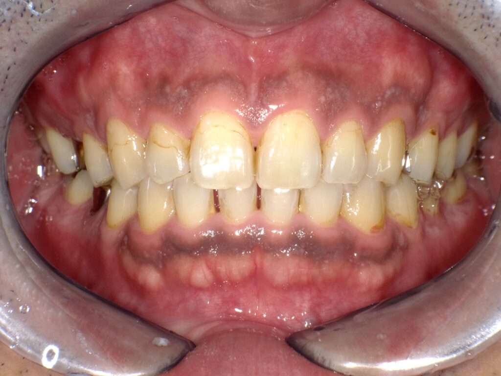 ホワイトニング症例ビフォー