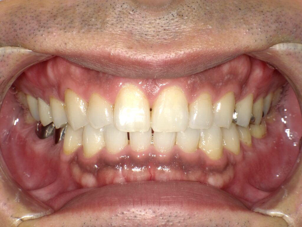 ホワイトニング症例アフター