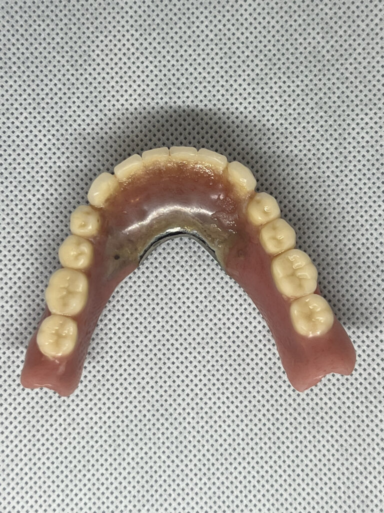 ロケーター義歯