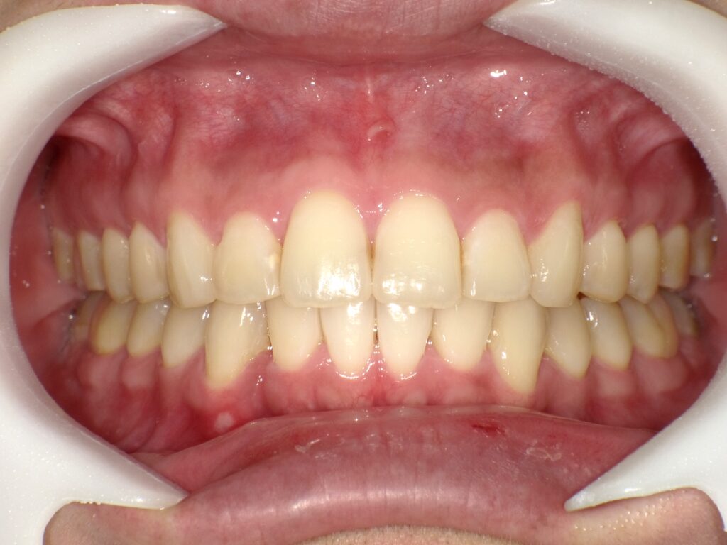 インビザライン症例ビフォー