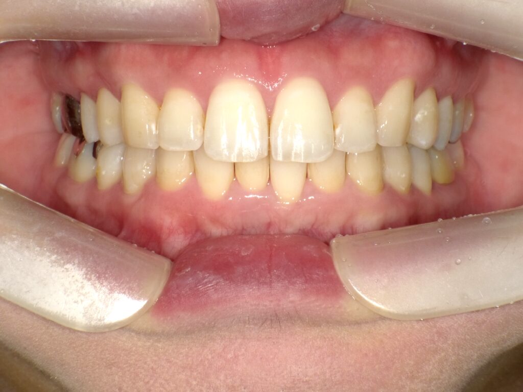 インビザライン症例アフター