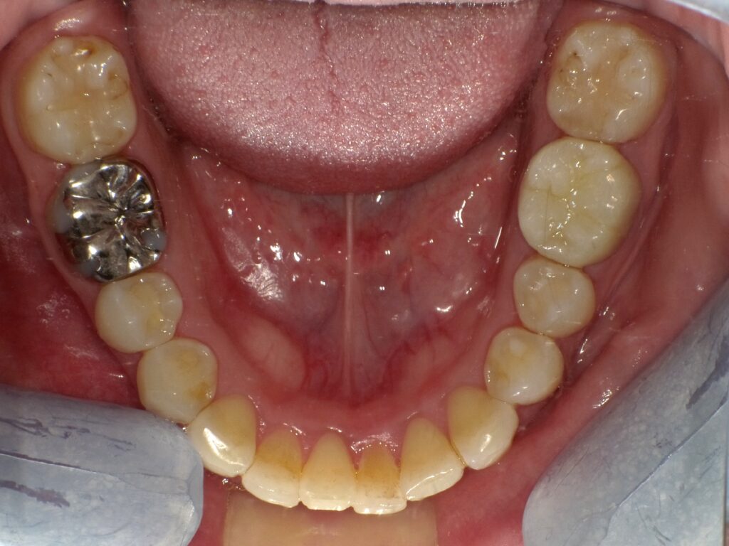 インビザライン症例アフター