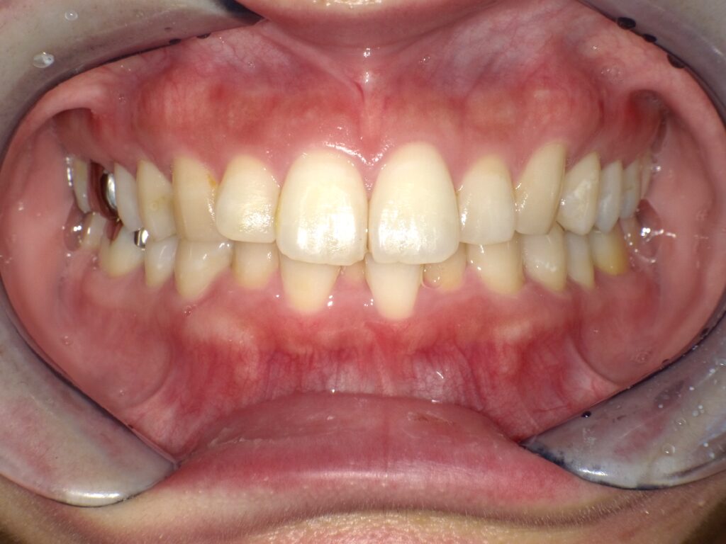 インビザライン症例ビフォー