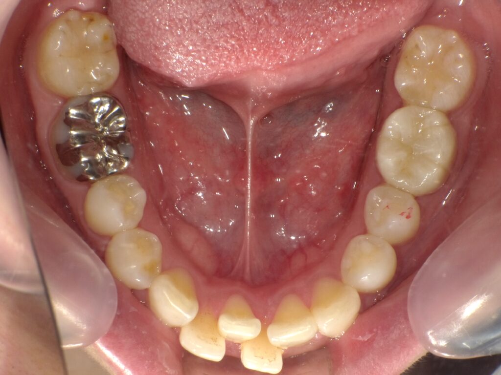 インビザライン症例ビフォー