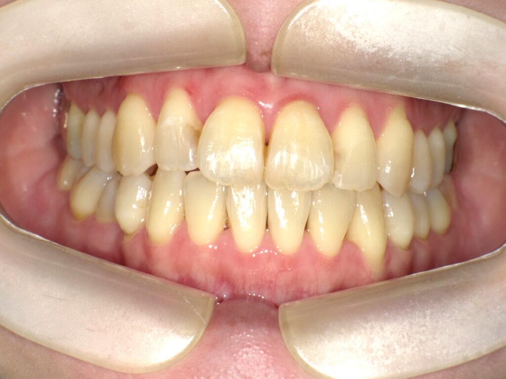 インビザライン症例アフター