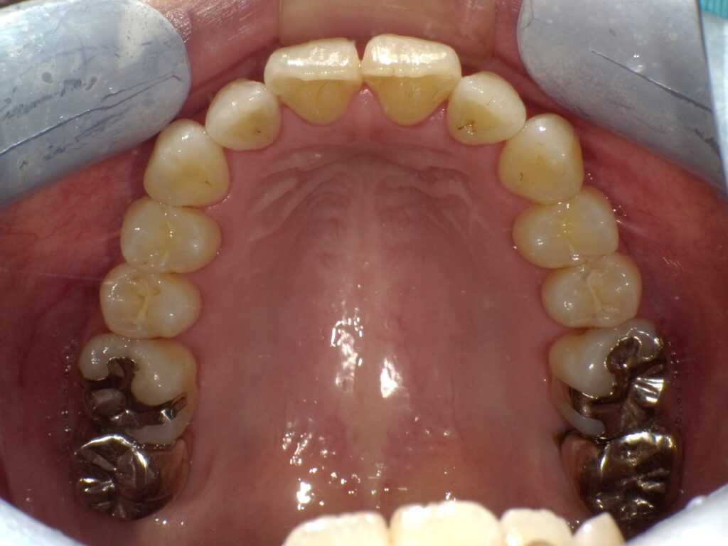 インビザライン症例アフター