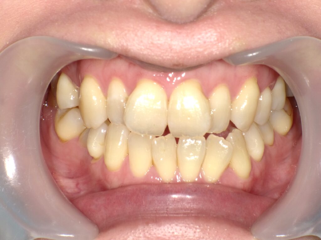 インビザライン症例ビフォー