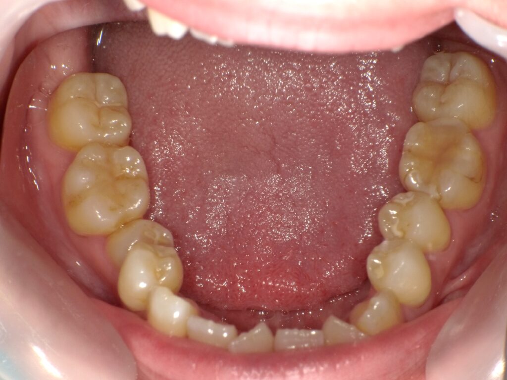 インビザライン症例ビフォー