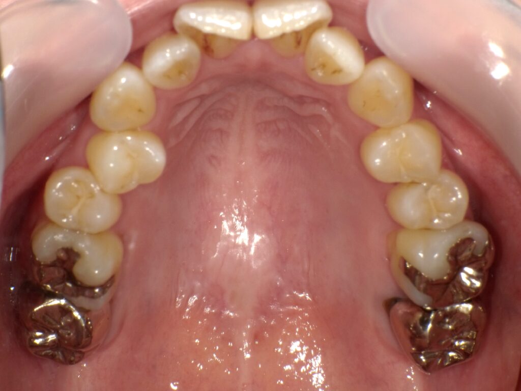 インビザライン症例ビフォー