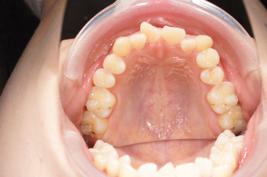 インビザライン症例ビフォー