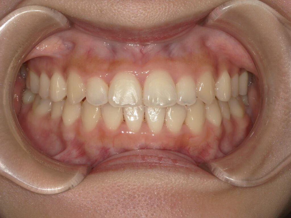 インビザライン症例アフター