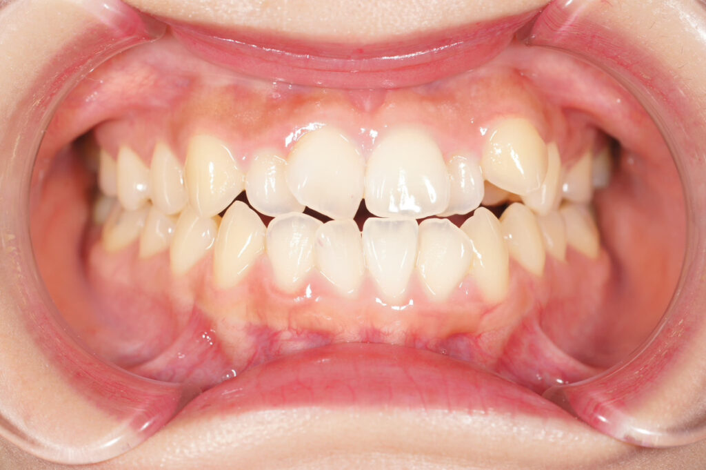 インビザライン症例ビフォー