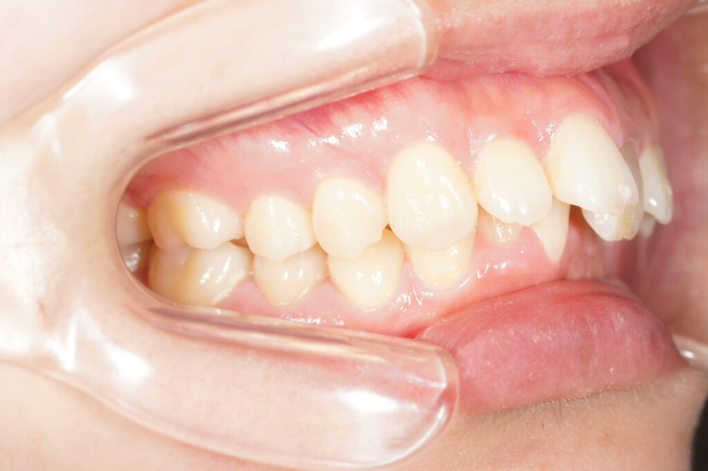インビザライン症例ビフォー