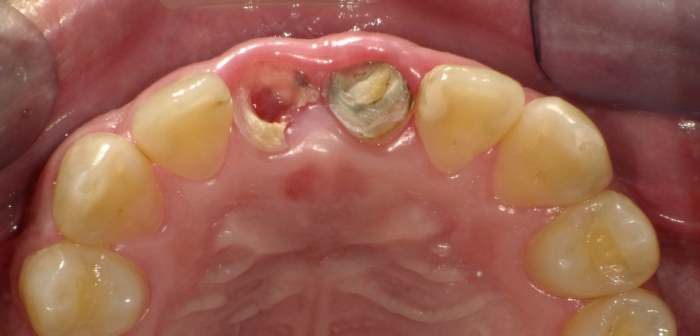 インプラント前
