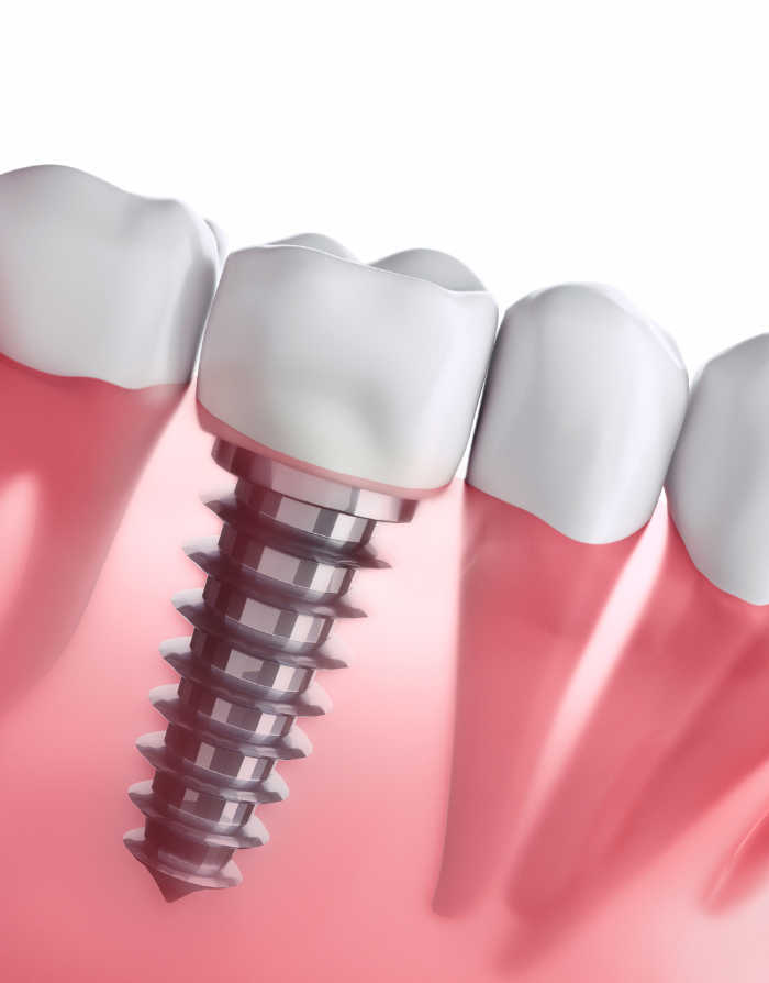 インプラント治療のイメージ