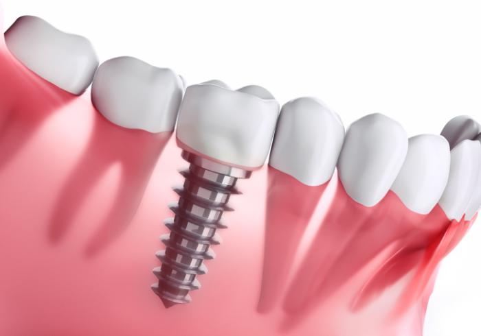 インプラント治療のイメージ