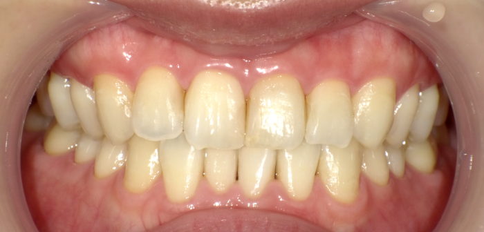 ホワイトニング後