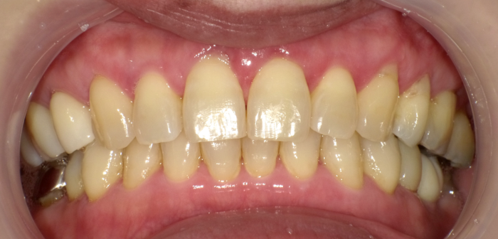 ホワイトニング前