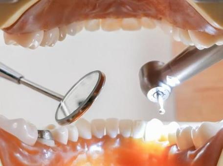 う蝕検知液使用中の口元