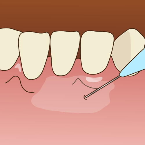 麻酔中のイラスト
