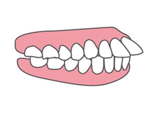 顎前突・下顎前突