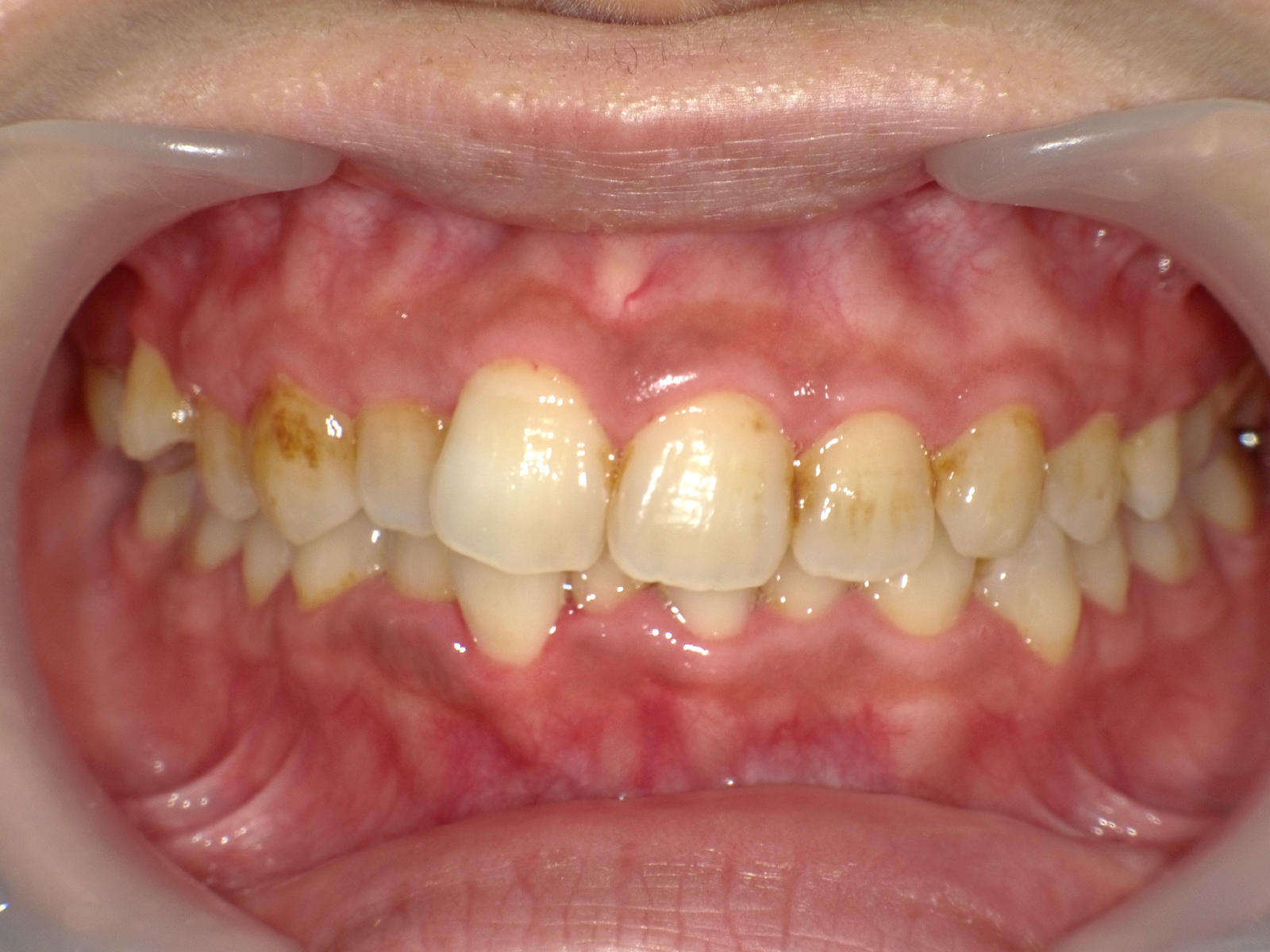 インビザライン症例ビフォー