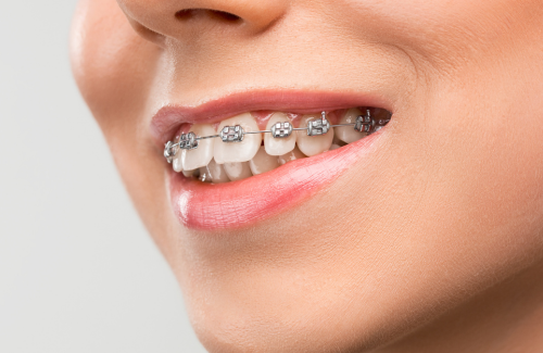 ワイヤー矯正中の口元