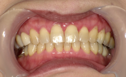 ホワイトニング治療前