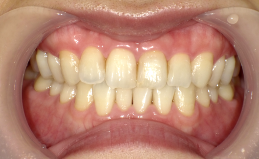 ホワイトニング治療後